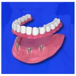 full mouth dental implants cost in mumbai